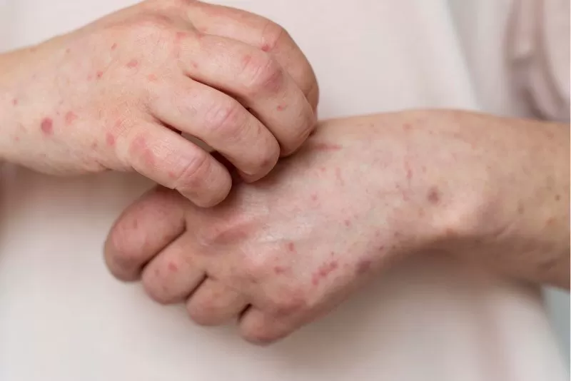 Em Tapauá, MPAM acompanha ações de prevenção e controle da Mpox